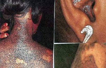 Health Minister Decries Increase In Use Of Skin Bleaching Cream Among Nigerians; As Nigeria Top List 